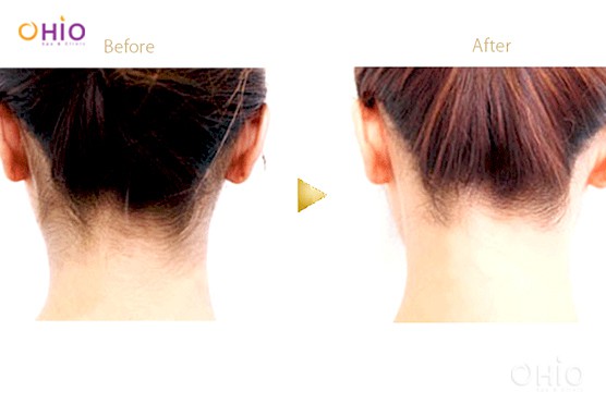 Triệt lông gáy với công nghệ laser diode M3 giúp bạn giảm thiểu sự khó chịu khi có tơ lông mọc lại. Bạn sẽ thấy tác động của công nghệ chứ không còn cảm giác đau rát. Hãy xem tấm hình thể hiện kết quả thực tế của phương pháp này.