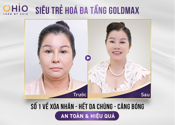 nang-co-xoa-nhan-goldmax-3