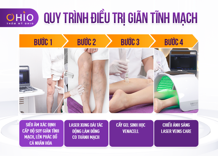 phác đồ trị giãn tĩnh mạch 3