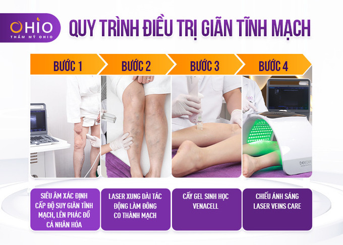 phác đồ trị giãn tĩnh mạch 2