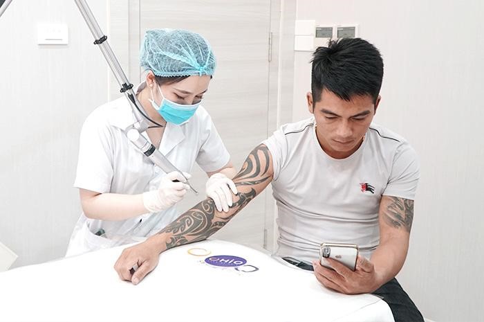 xóa xăm bằng laser