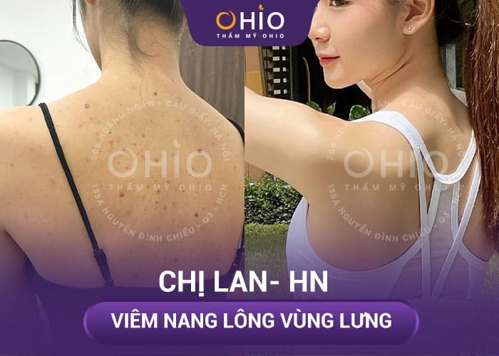 Chị Lan- HN Viêm nang lông vùng lưng