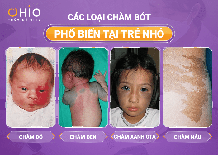 Vết chàm đỏ bẩm sinh 3