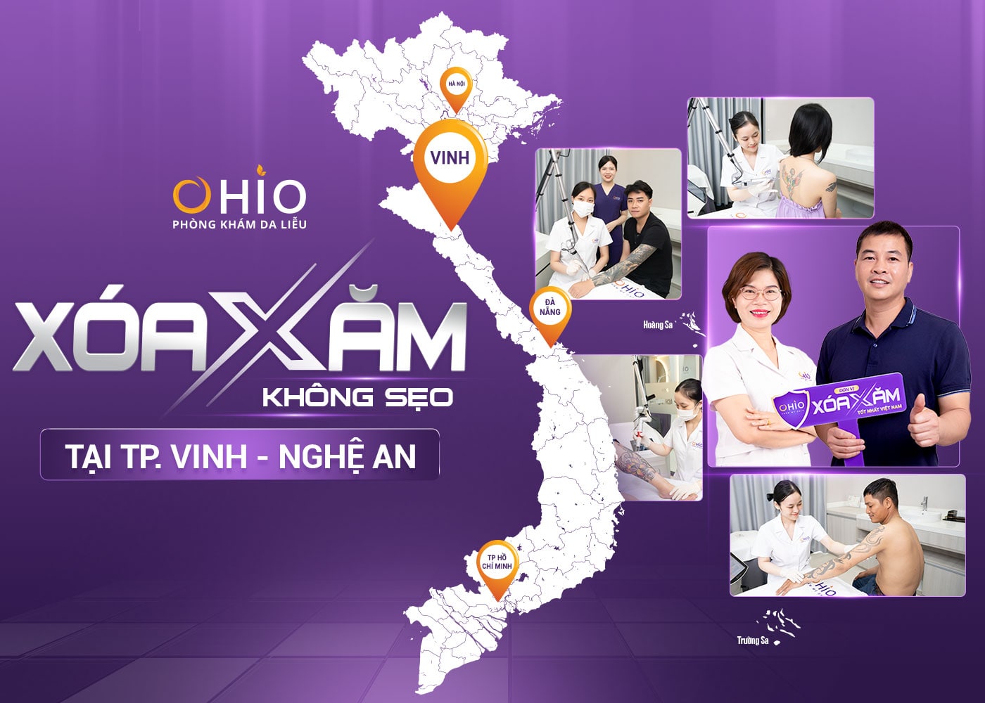 Xóa xăm không sẹo tại OHIO Vinh - Nghệ An