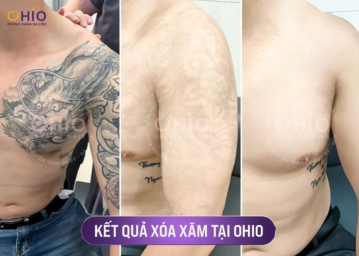 Kết quả xóa xăm tại OHIO