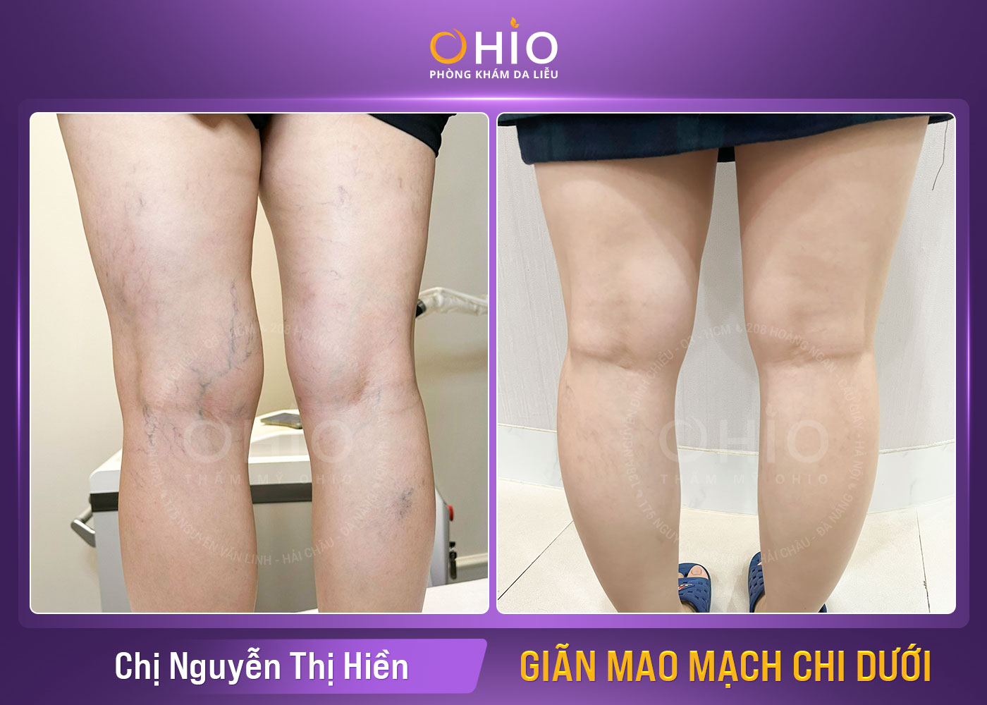 Chị Nguyễn Thị Hiền- Giãn mao mạch chi dưới