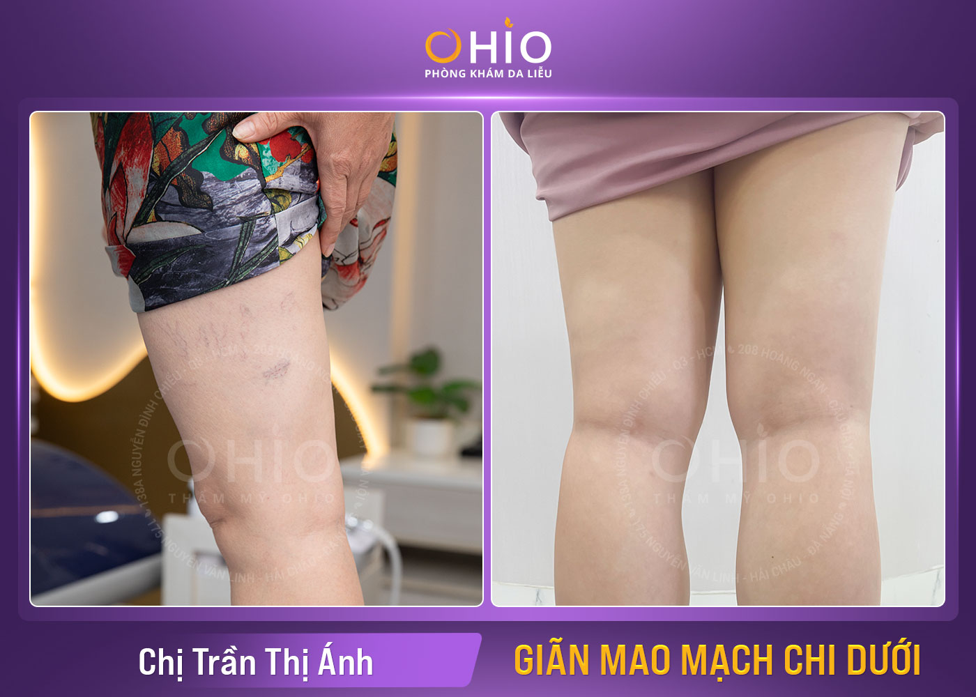 Chị Trần Thị Ánh - Giãn mao mạch chi dưới