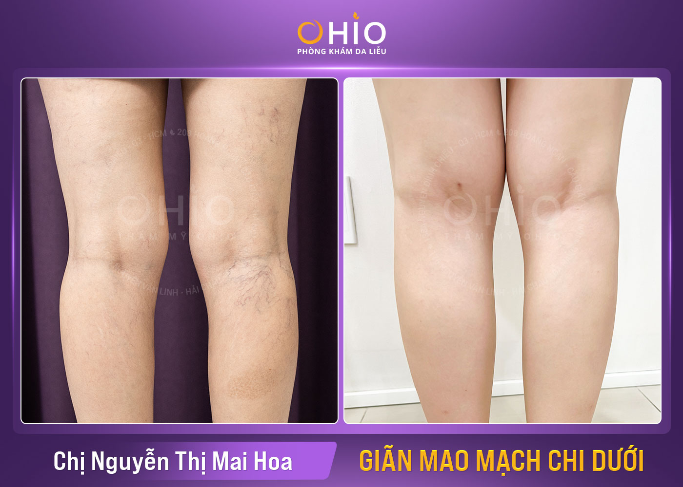 Chị Nguyễn Thị Mai Hoa - Giãn mao mạch chi dưới