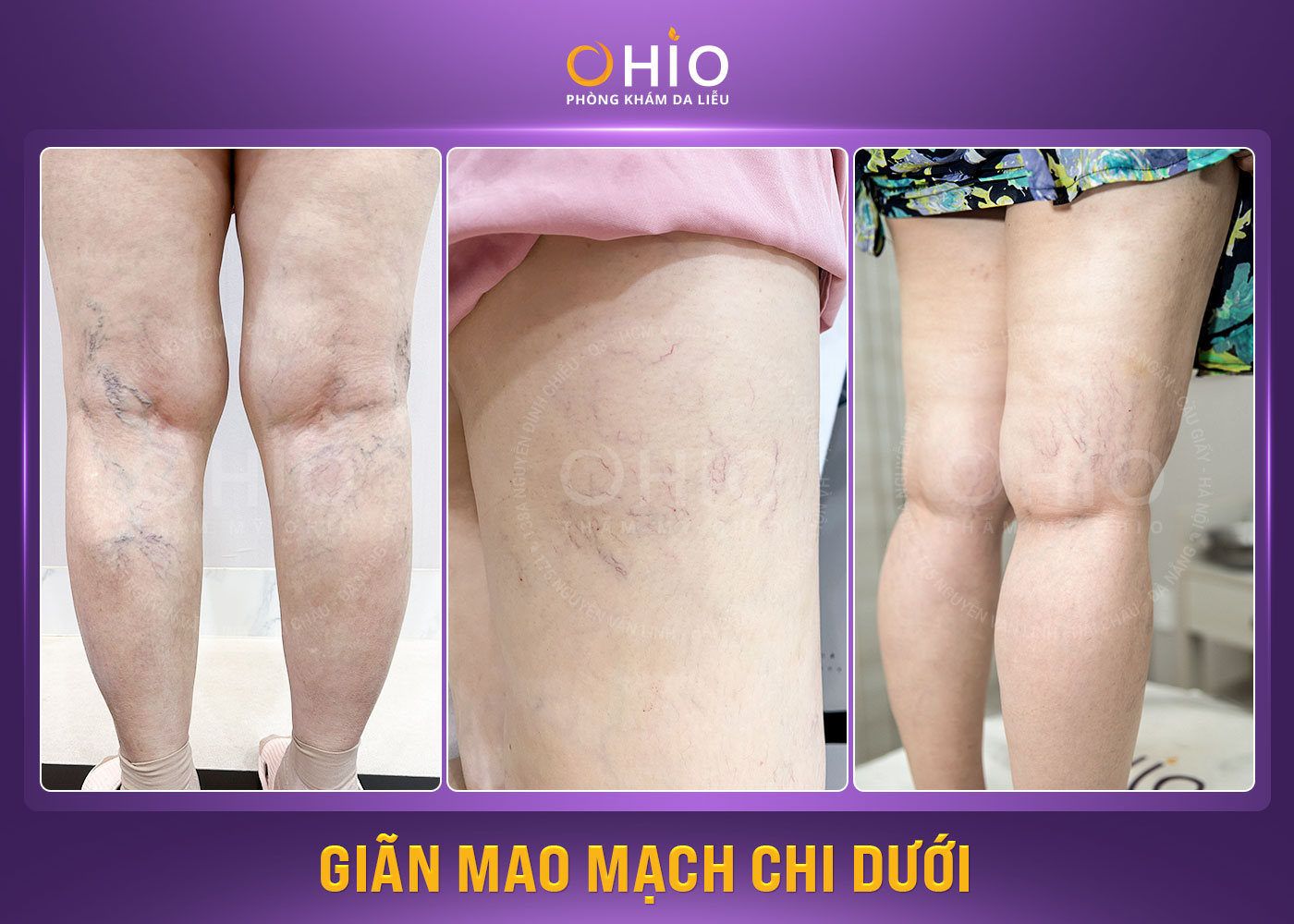 Các tình trạng giãn mao mạch chi dưới