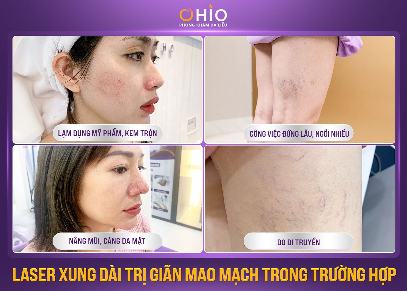 Đối tượng nào nên điều trị giãn mao mạch bằng Tổ hợp laser xung dài