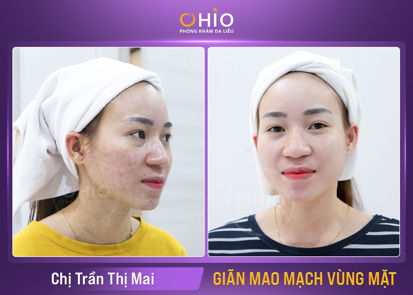 Chị Trần Thị Mai ( 35tuổi) – Trị giãn mao mạch mặt hiệu quả