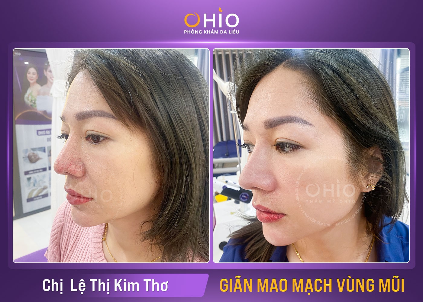 Chị Kim Thơ ( 30 tuổi) – Trị giãn mao mạch mặt hiệu quả