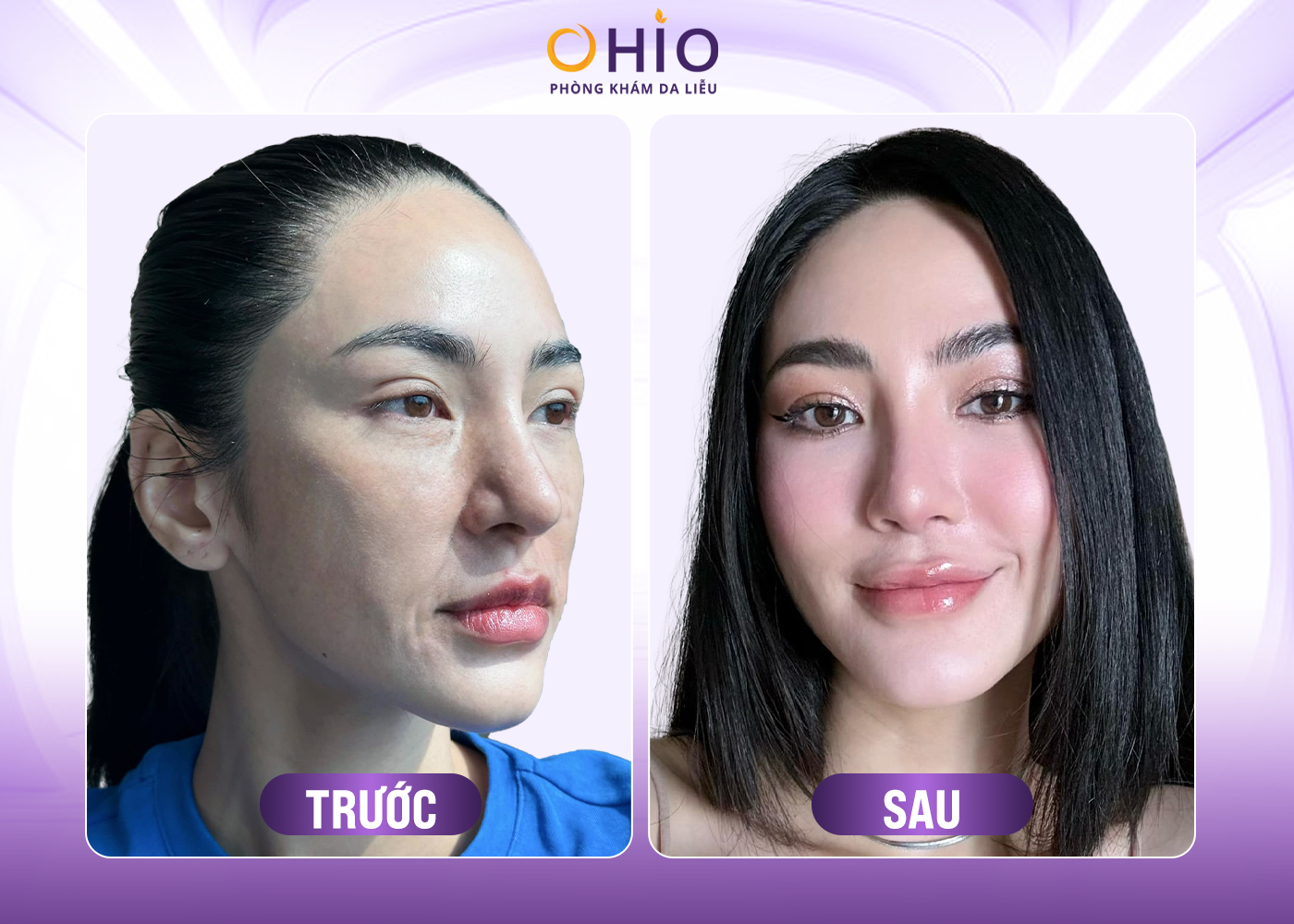 hình ảnh trẻ hóa bằng công nghệ Ultherapy 