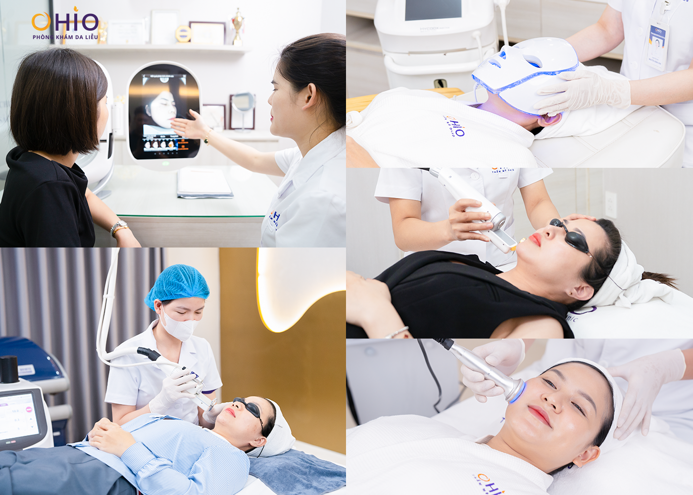 Tổ hợp Laser xung dài triệu đô trị giãn mao mạch hiệu quả